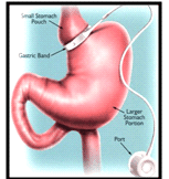 laparoscopic adjustable gastric band surgery graphic