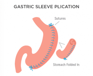 illustration of graphic sleeve plication