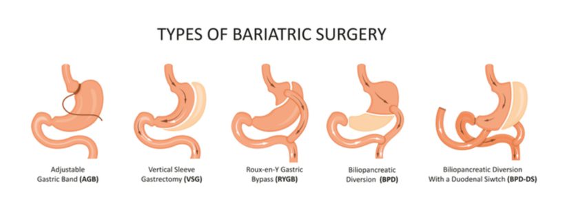 graphic showing five types of bariatric surgery